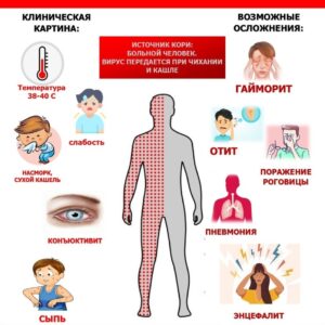 Корь. Как защититься от вируса?