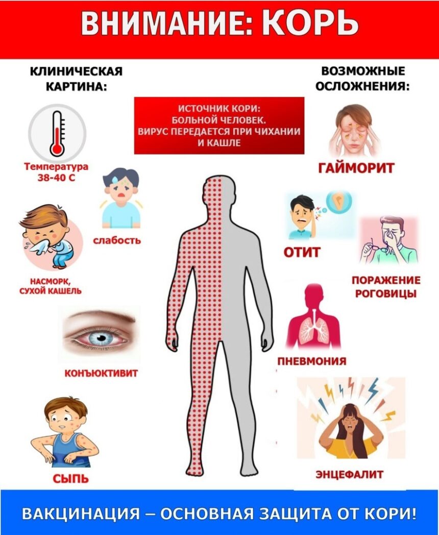 Корь. Как защититься от вируса?