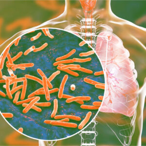 Что мы знаем о туберкулезе?