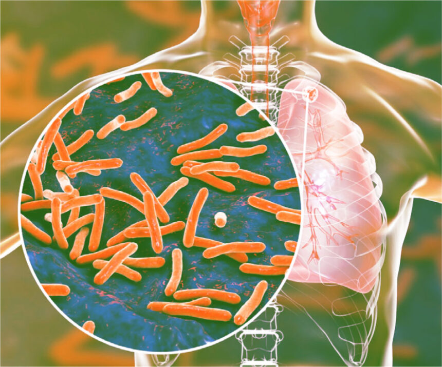 Что мы знаем о туберкулезе?